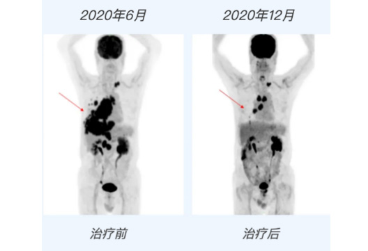 早发现、早治疗 “硬核检验”助力肿瘤防治